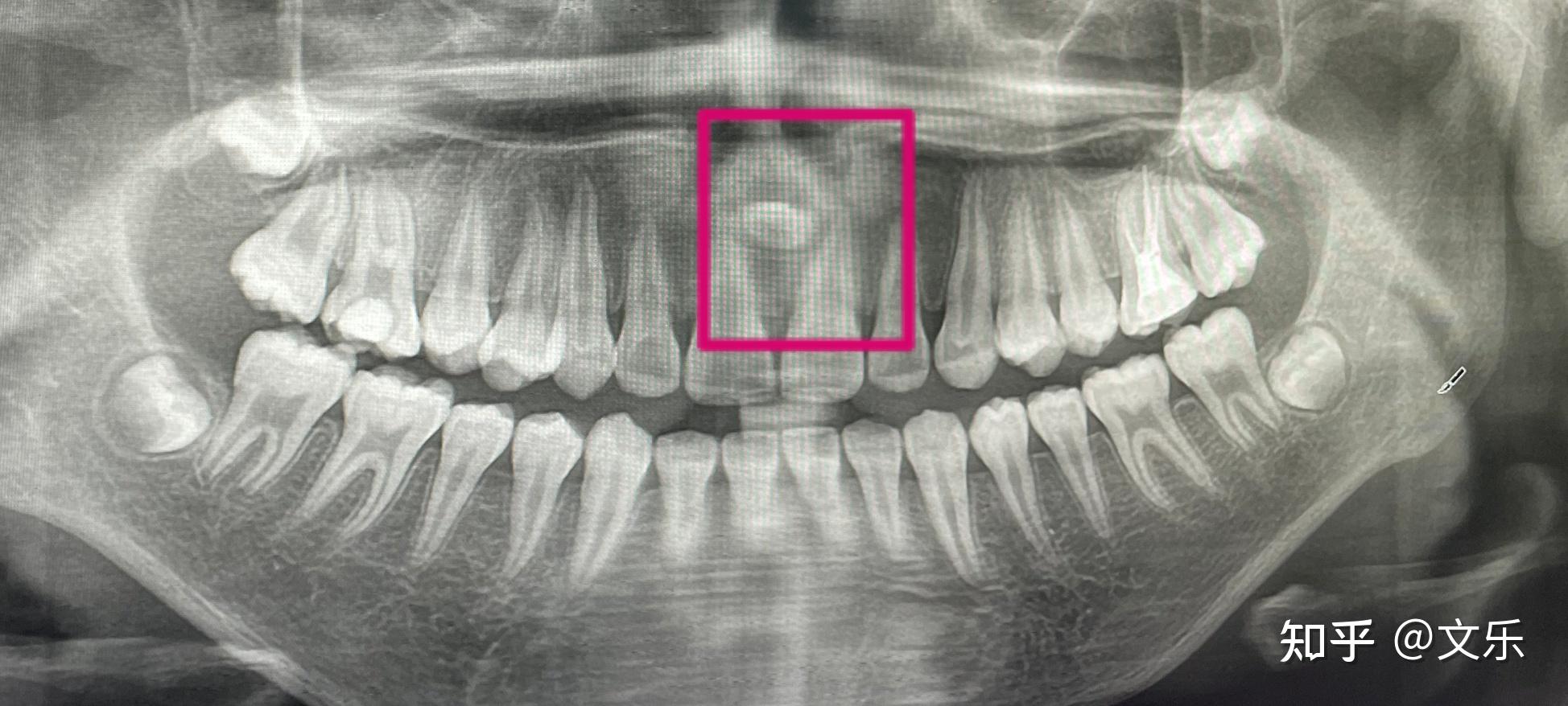 儿童上颌前牙区埋伏多生牙的处理思路 - 知乎