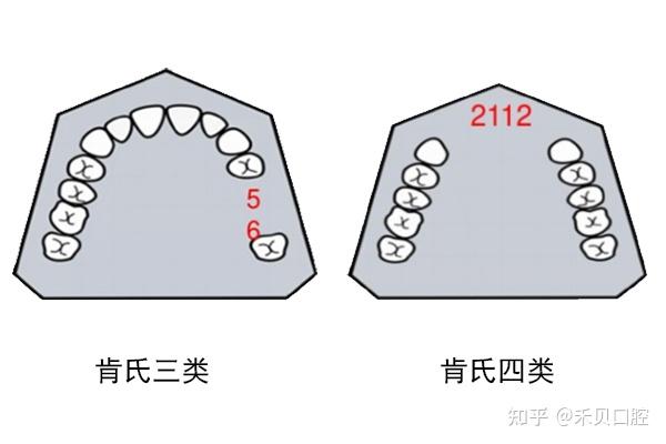 牙列缺损是什么?如何修复牙列缺损? - 知乎