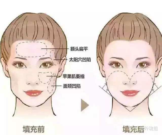 对于面部脂肪比较多的人而言,线雕可以结合热玛吉一起做.