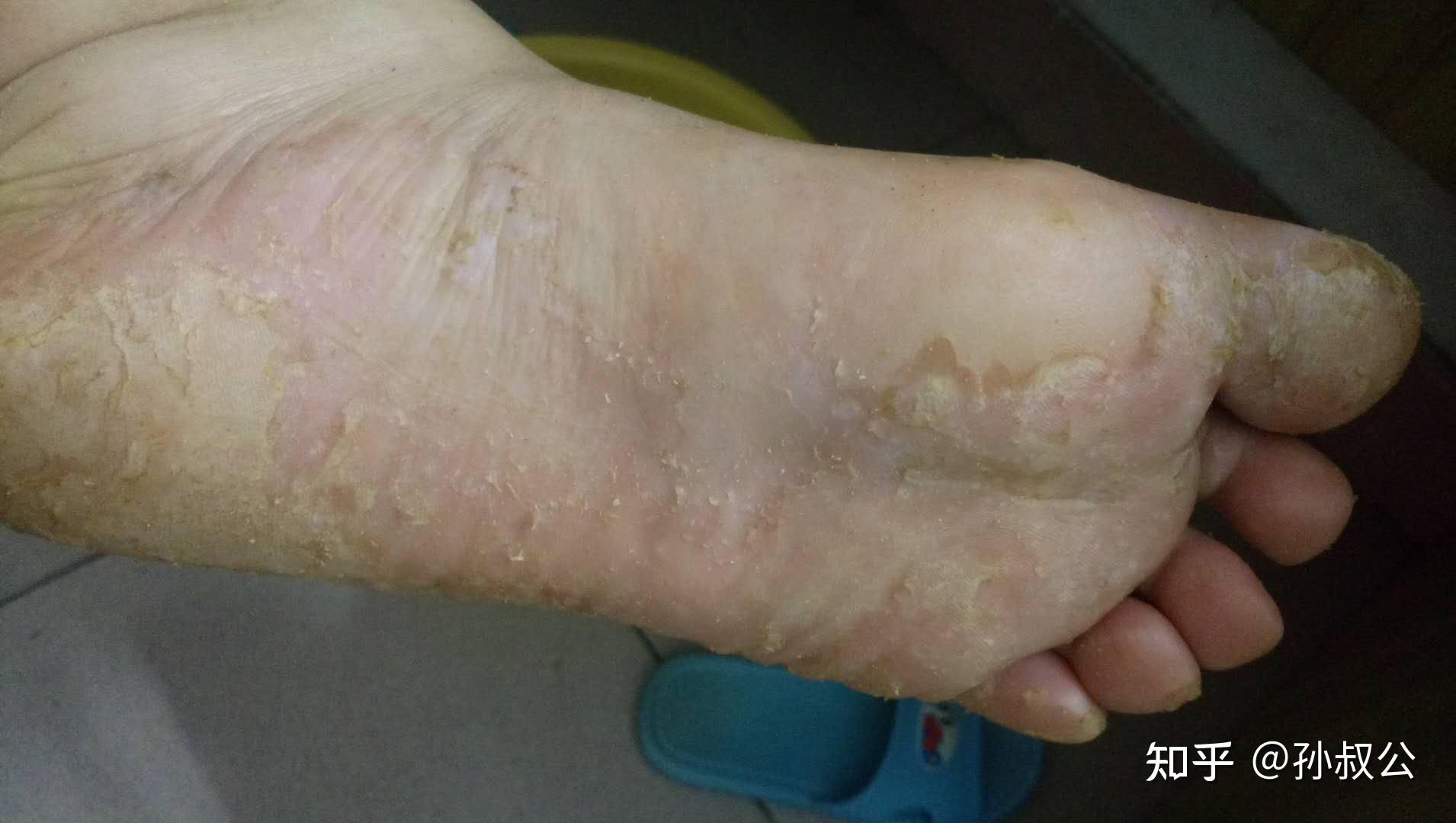 脚气脚底起水泡怎样办