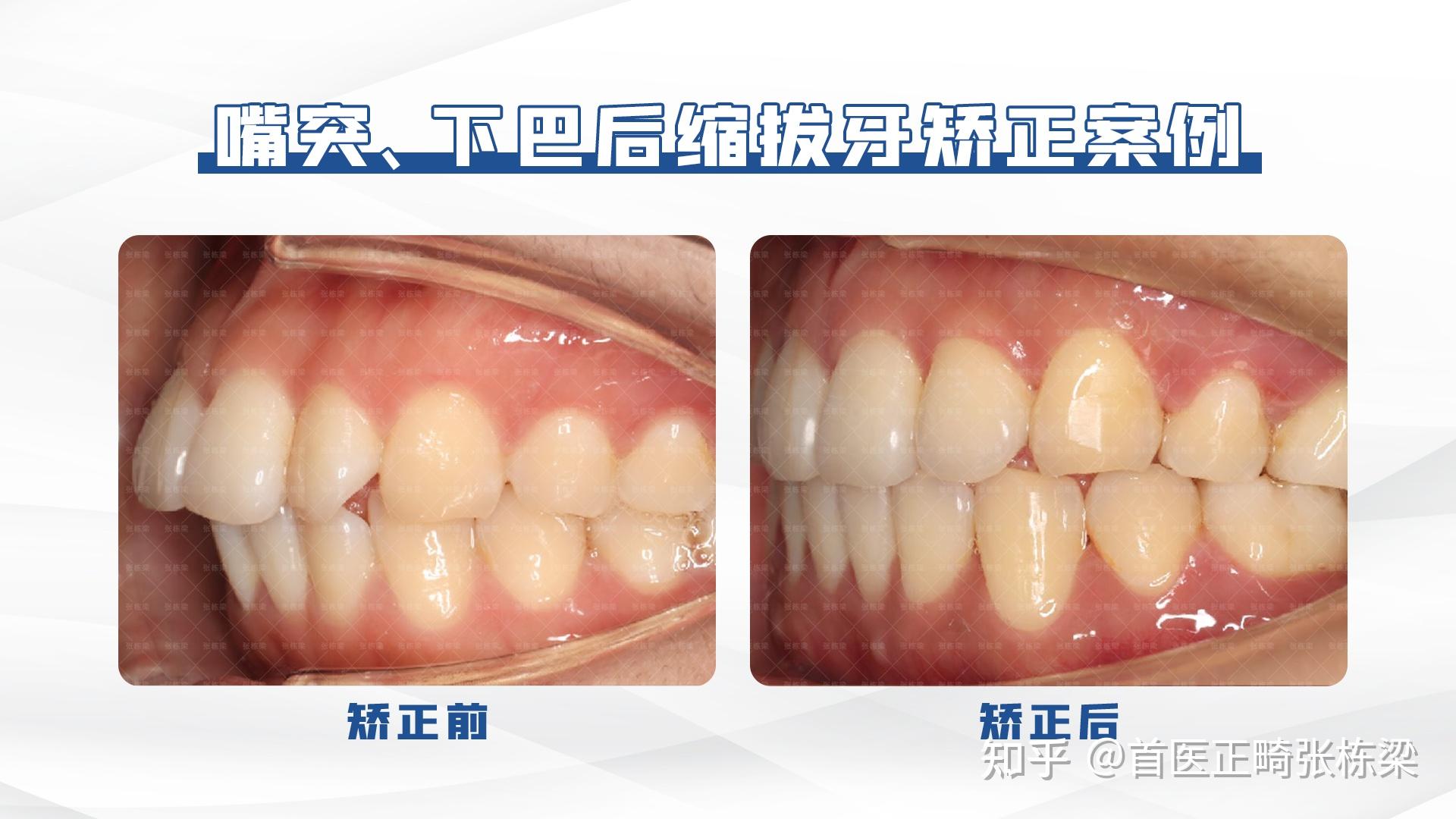 北京牙齿矫正 | 高难度骨性前突没下巴,舌侧牙齿矫正重获自信! - 知乎