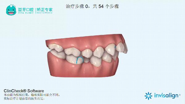 com/treatment/t-1216牙