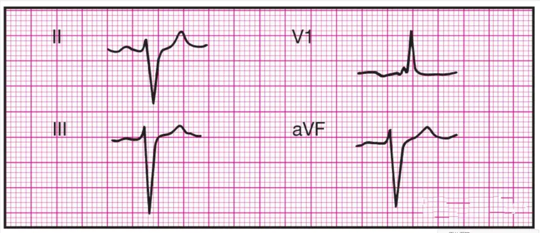 14种异常心电图的波形特点建议收藏