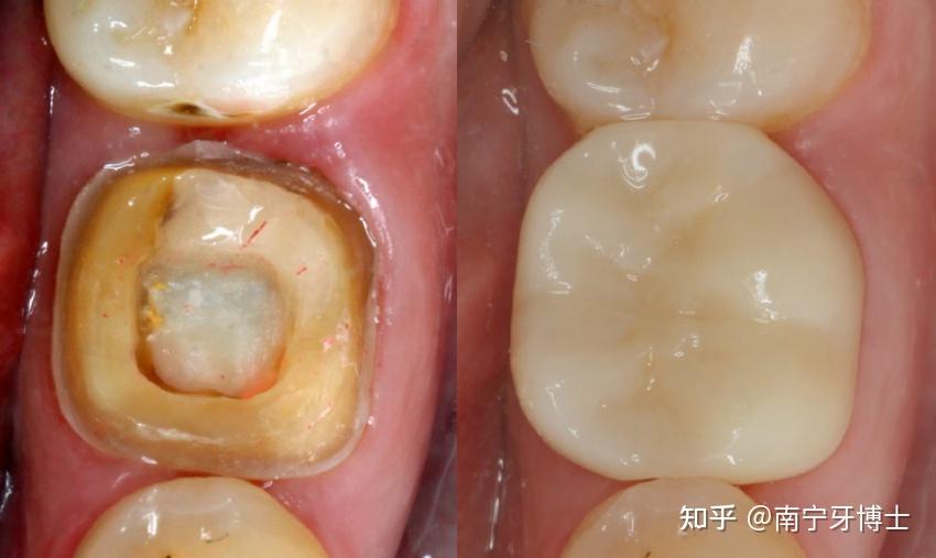 在線解答根管治療後一定要戴牙冠嗎