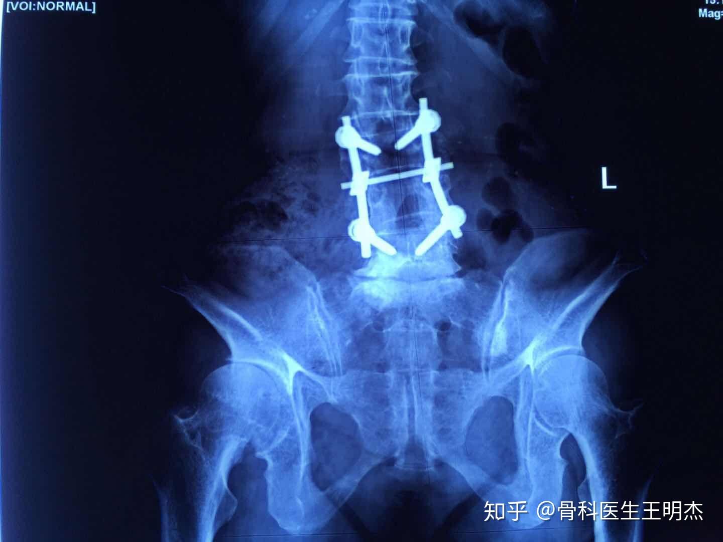 腰椎双侧椎弓根螺钉固定三维有限元分析-上海赛一信息科技中心