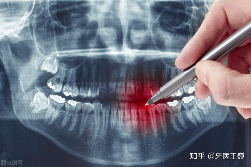 牙槽骨骨质增生图片