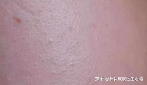 科普 | 逆光疹（看不见的小疙瘩） - 知乎