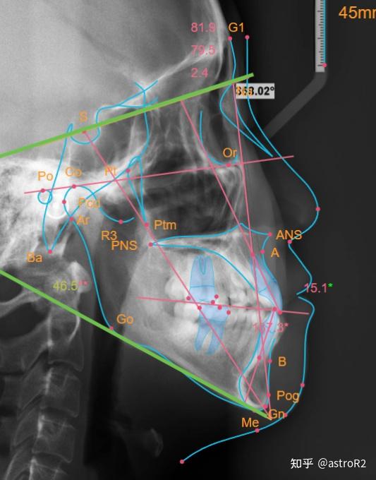 口腔 / 我和口腔科的故事(8): 北大口腔正畸篇-x线头影测量图解
