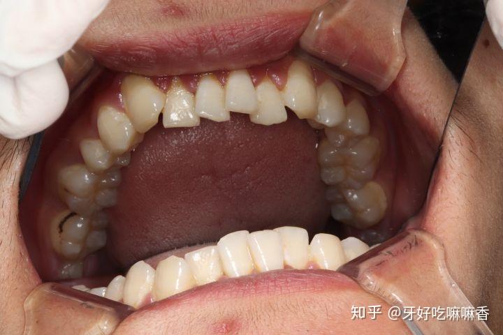 矯正牙齒必須全部戴牙套不能做局部嗎