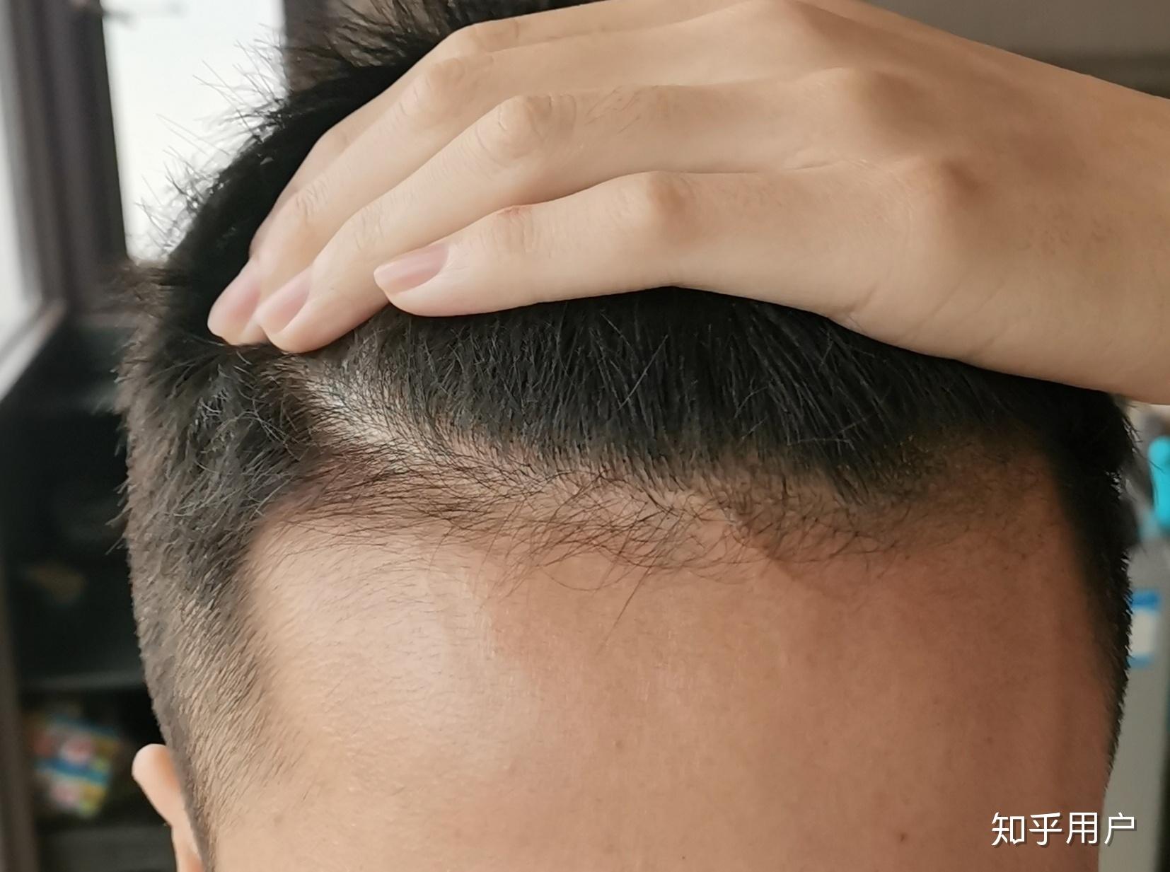 用米诺涂抹在发际线和额角3个月了变得更秃有长一点小绒毛我该不该