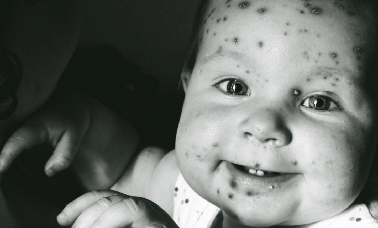 水痘痊愈就终生免疫?其实病毒可能仍在潜伏,随