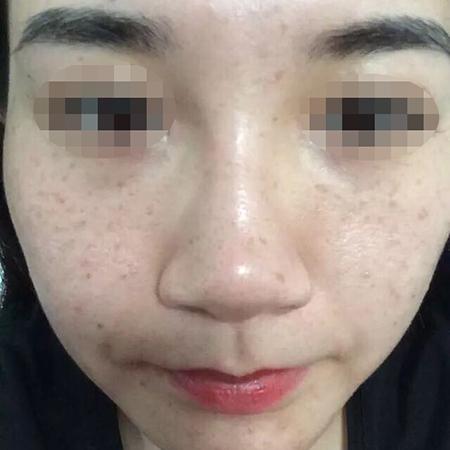 西方女孩去美容院种雀斑长雀斑是不是真的美
