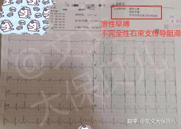 核保实例 房性早搏 不完全性右束支传到阻滞 三尖瓣返流 重疾险标准体承保 知乎