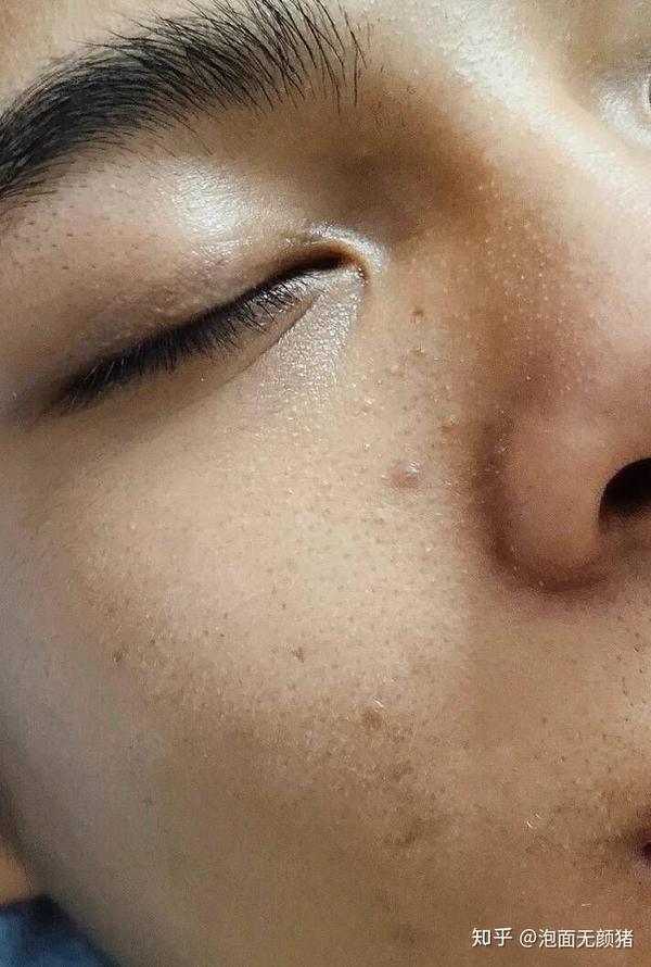 问:男生脸上毛孔粗大咋办?