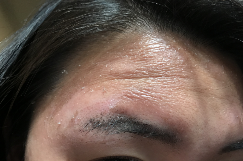 严重晒伤后我的修复护肤之宝! - 知乎