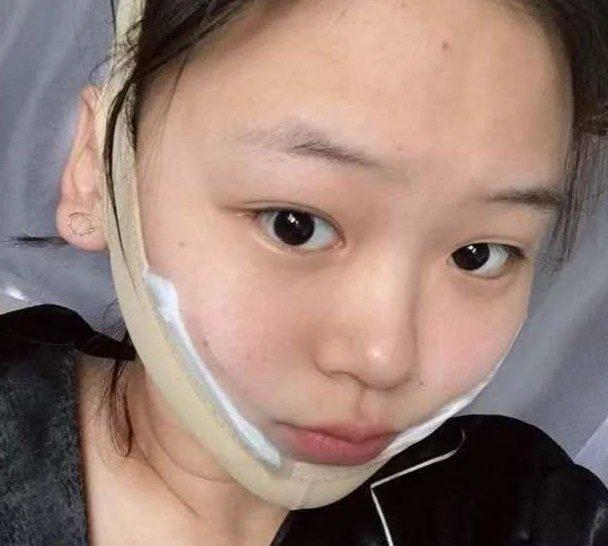 重庆下颌角案例颊脂垫肥大改善