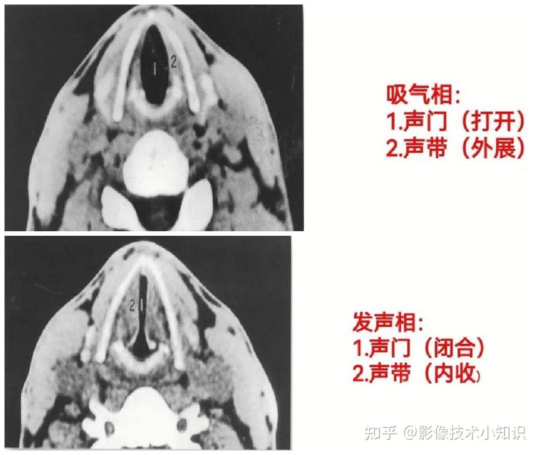 喉的CT解剖 - 知乎