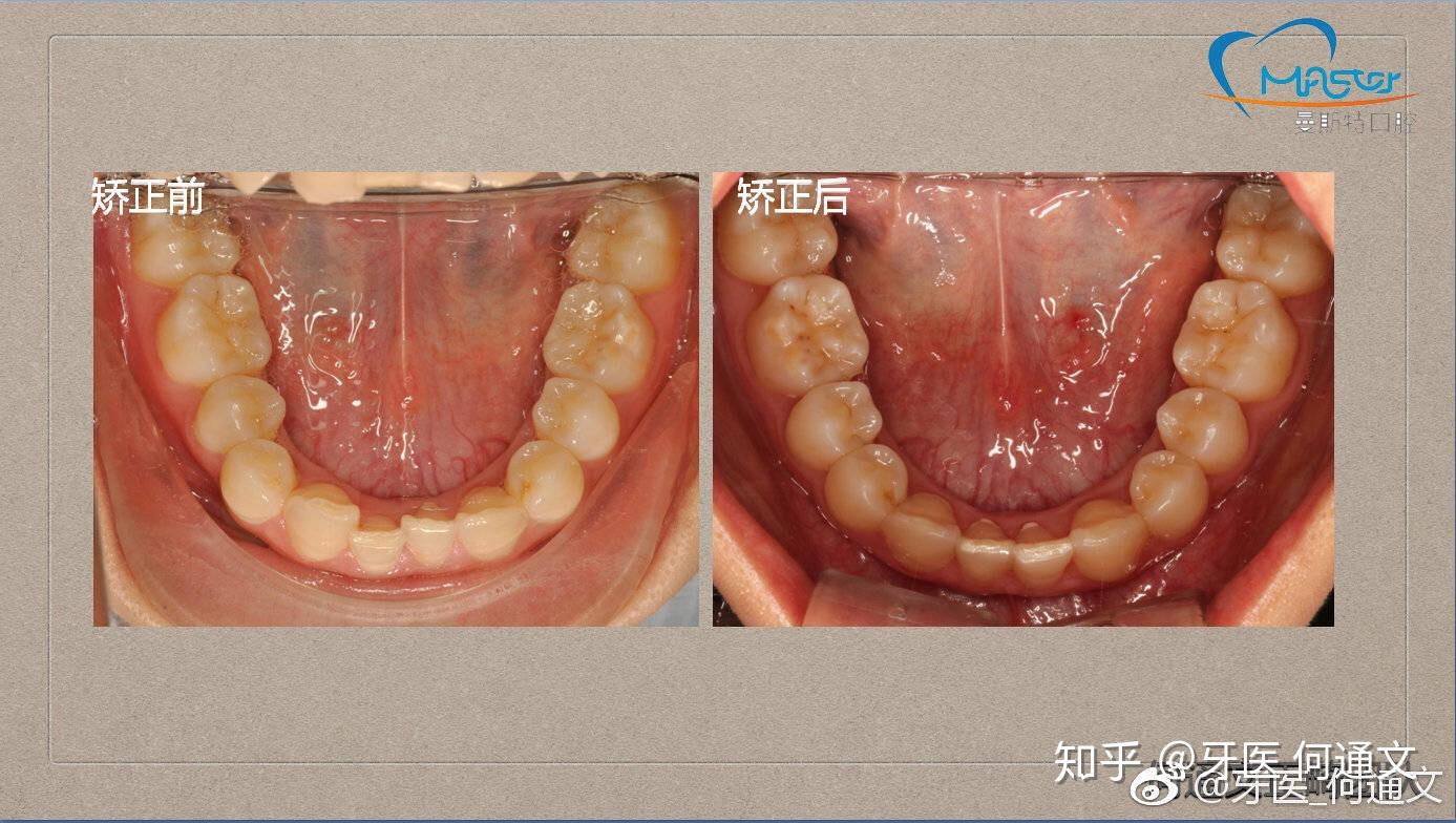 病例簡介:患者由於缺失左上第一前磨牙及兩顆下頜切牙,導致牙齒比例