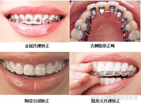 常见几种矫正方式对比