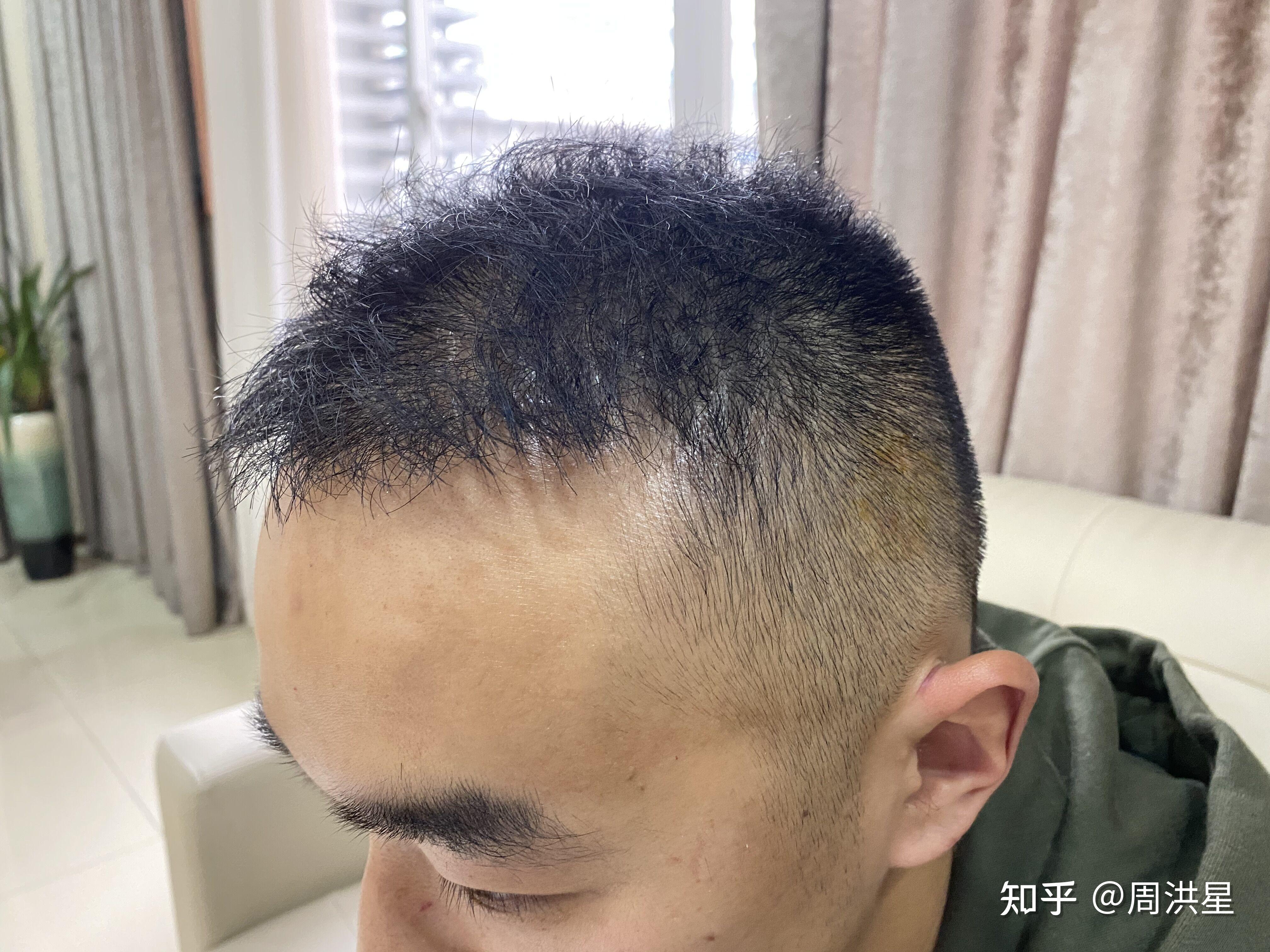 26岁就大秃,植发5000单位的他如今长这样 - 知乎