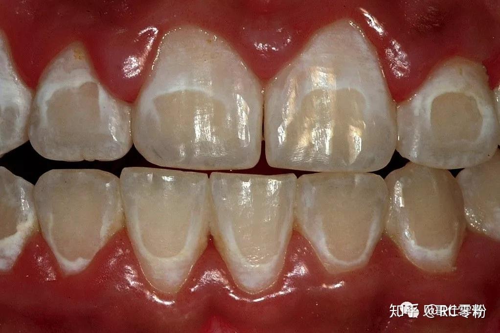 请问像我这样的牙齿怎么变白,是什么原因导致的黄牙,该怎么治疗呢?