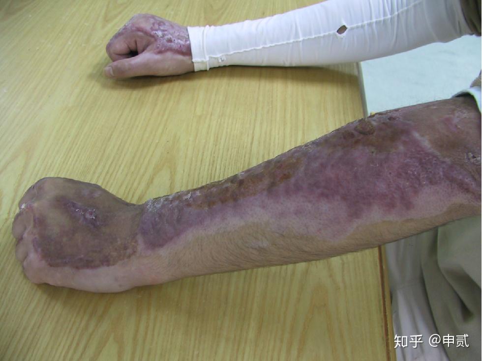 烧伤的康复治疗