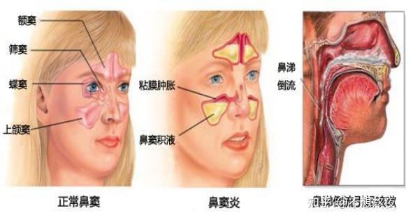 鼻炎和正常鼻子图解图片