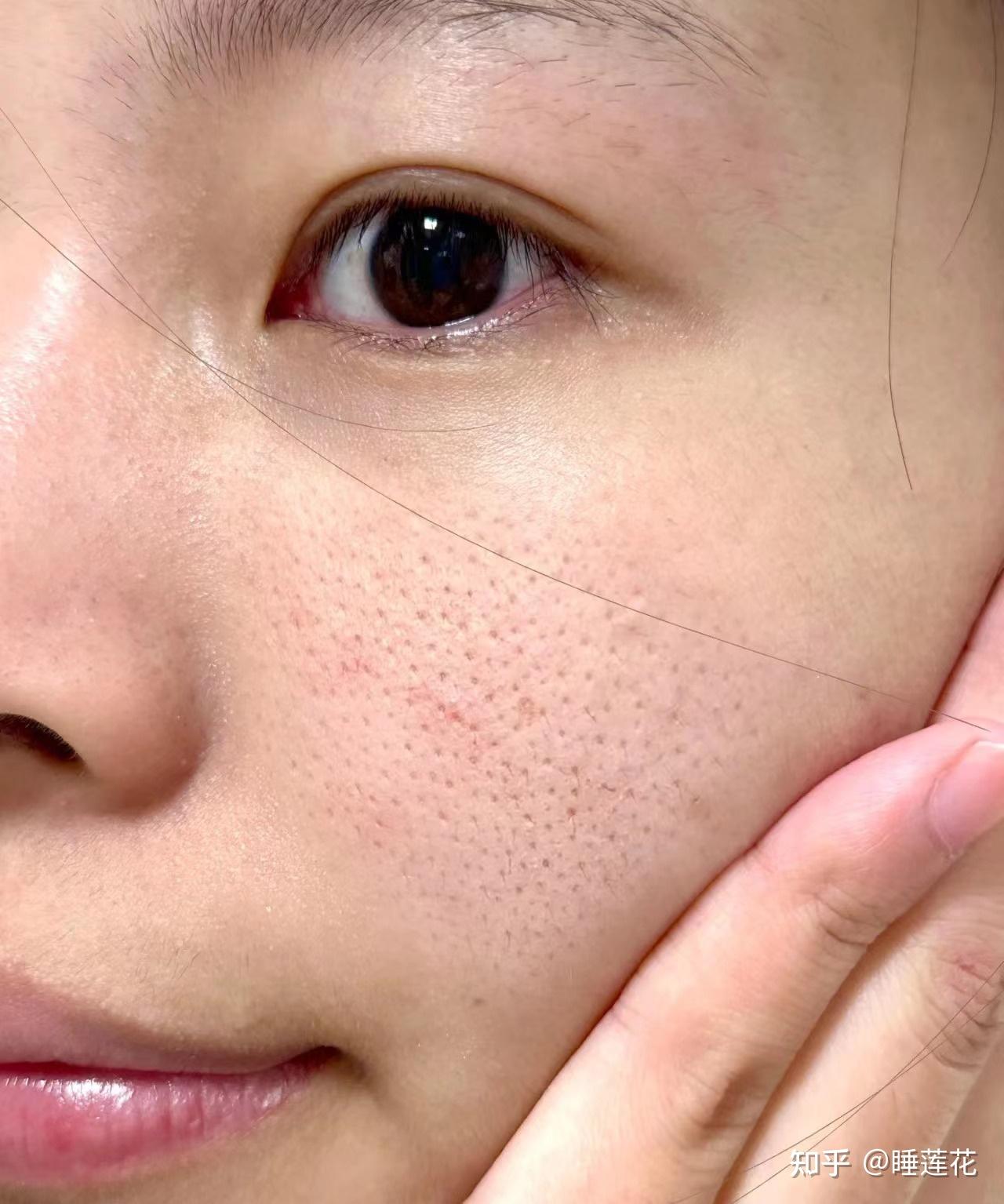 【5年毛孔粗大经验贴】如果你脸上毛孔粗大,黑头阻塞,痘印反复脸上皮肤差可以看看我的经历! - 知乎