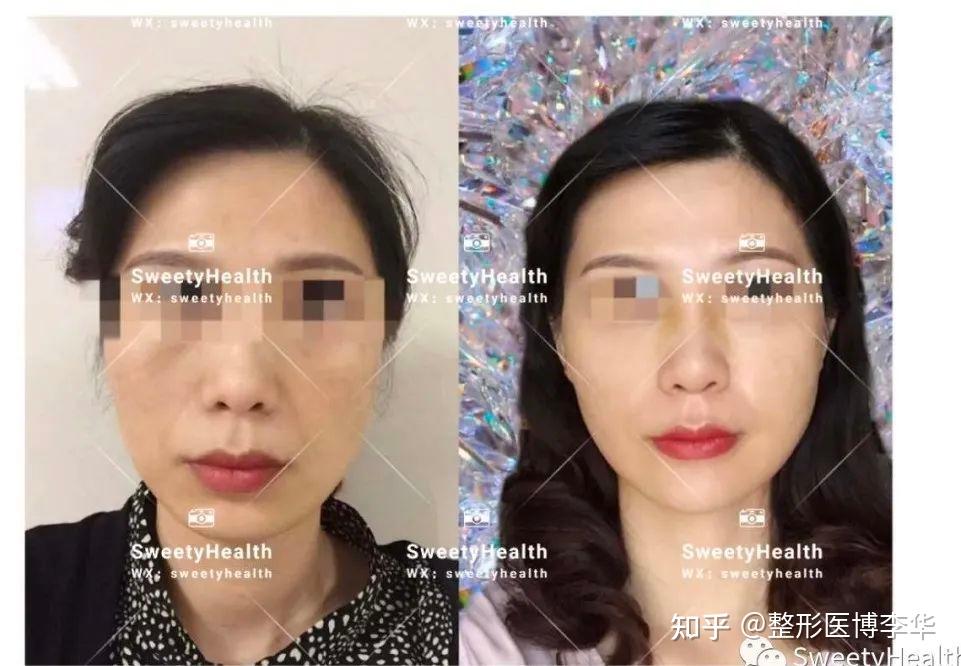 SVF脂肪胶填充案例分享 - 知乎