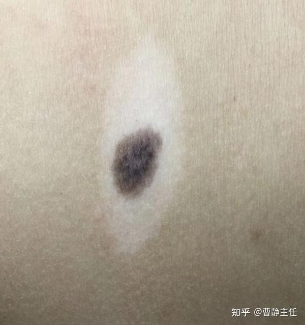 晕痣白癜风不一般,教你认识它。 - 知乎