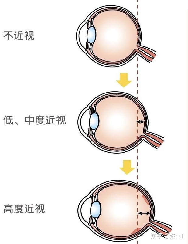 我们现在大部分儿童近视是由于眼轴拉长造成远视:就是在调节放松的