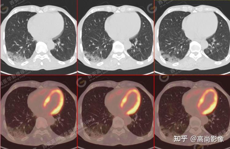 pet/ct病例—肺粘液腺癌,历经3年余终确诊【西安高尚医学影像诊断中心