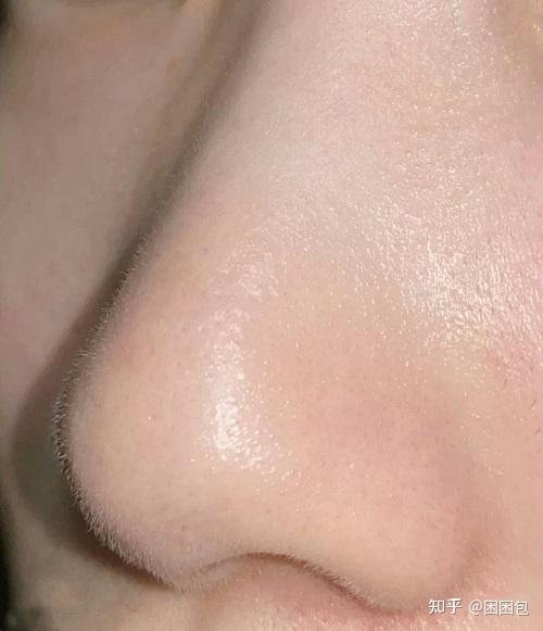 鼻子上黑头很严重毛孔粗大怎么办