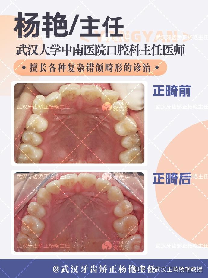 #武汉牙齿矫正:正畸矫正面部不对称,闭合间隙恢复正常咬合 - 知乎