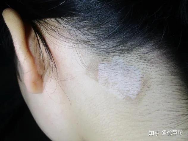 白癜风一定要早发现早治疗那么早期的白斑症状有哪些