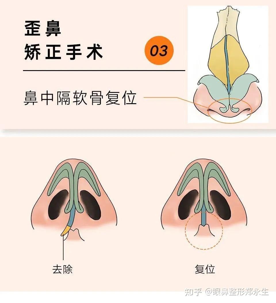 截骨后需配戴鼻夹板固定;鼻中隔偏曲矫正也建议配戴鼻夹板,这样会更加