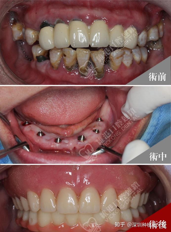 深圳全口种植牙案例分享