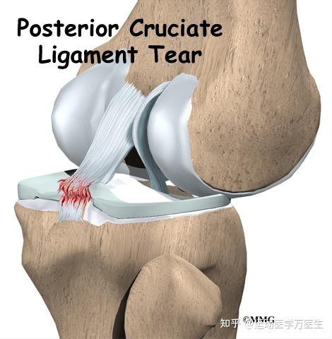 后交叉韧带撕裂了该怎么办