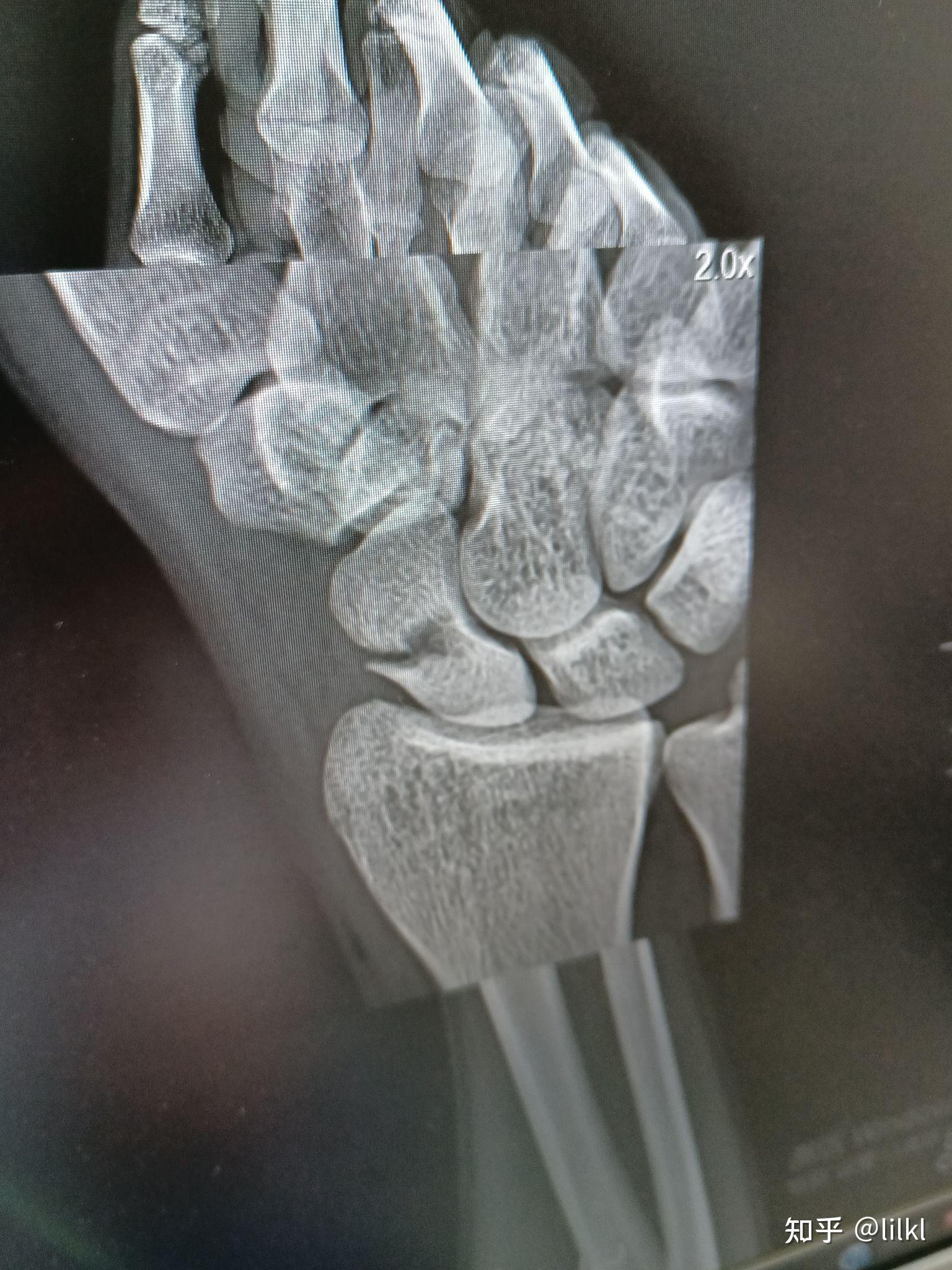 陈旧性手腕舟状骨腰部骨折康复日记