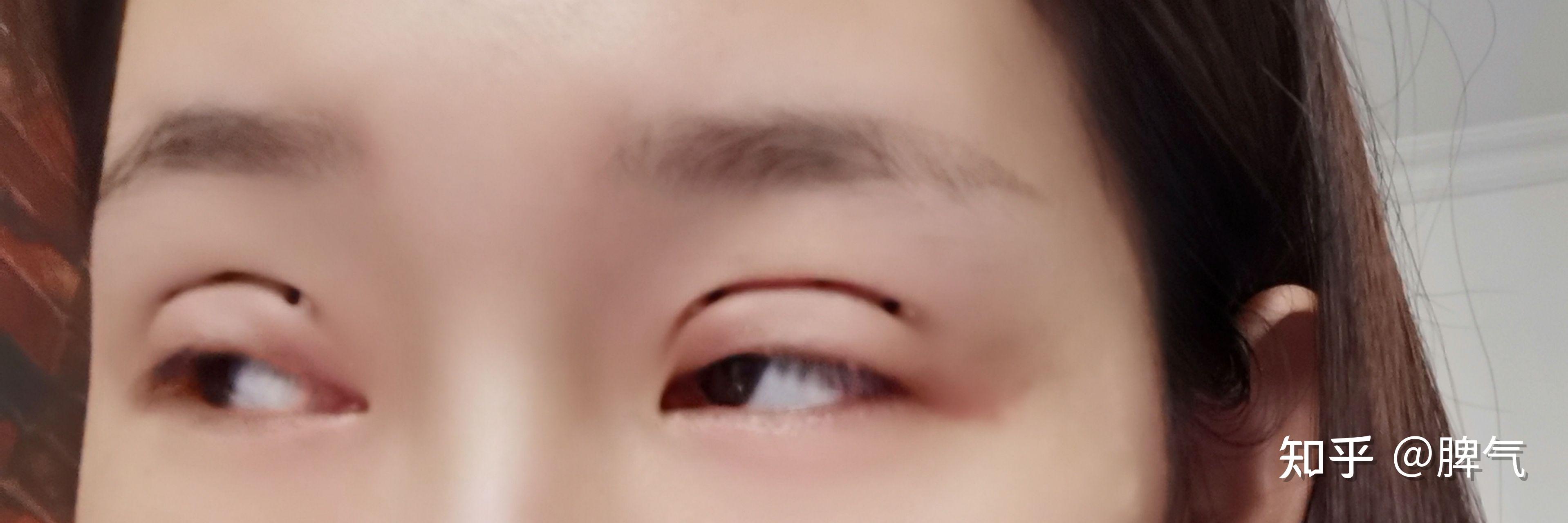 三点式双眼皮（北京医院丁金萍）系列案例六十五 - 知乎