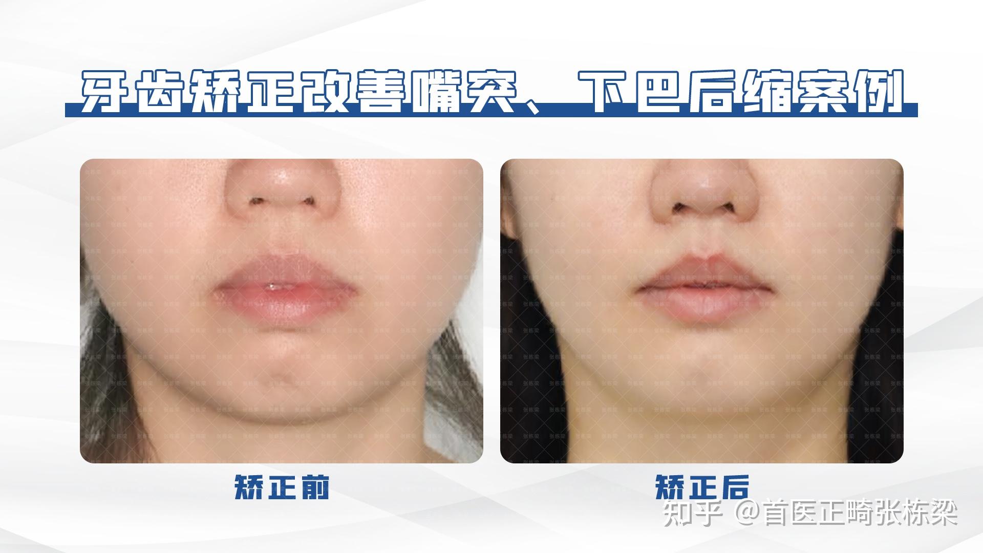 牙齿前突,下巴后缩正畸案例