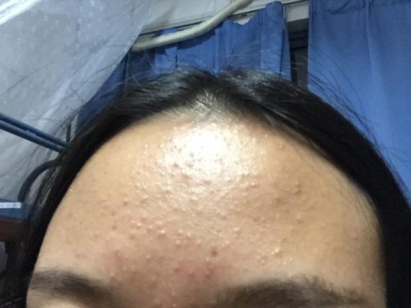 一般来说阿达帕林对付微粉刺比较好,如果肉眼可见的粉刺,效果就比较差