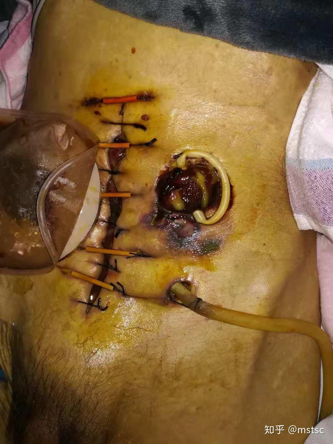 一个月3次手术就这样没了