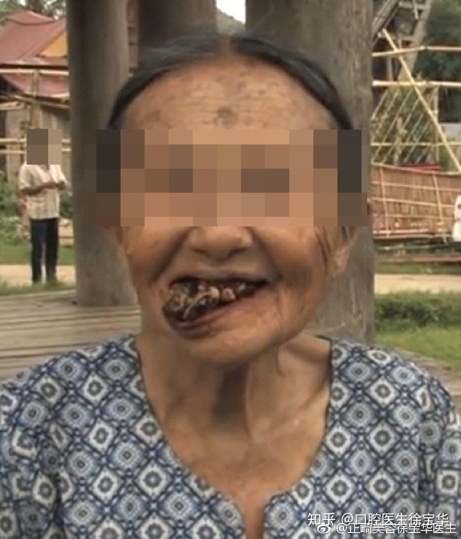 槟榔的危害口腔图片
