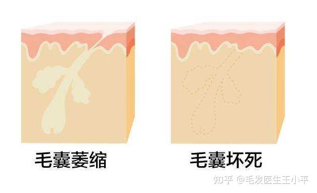 大麦植发医生科普|头秃了，体毛却很旺盛，为什么？ - 知乎