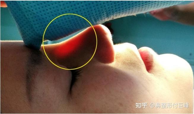 大家都在整鼻子为什么有些人的更自然说说筋膜在隆鼻手术中的运用