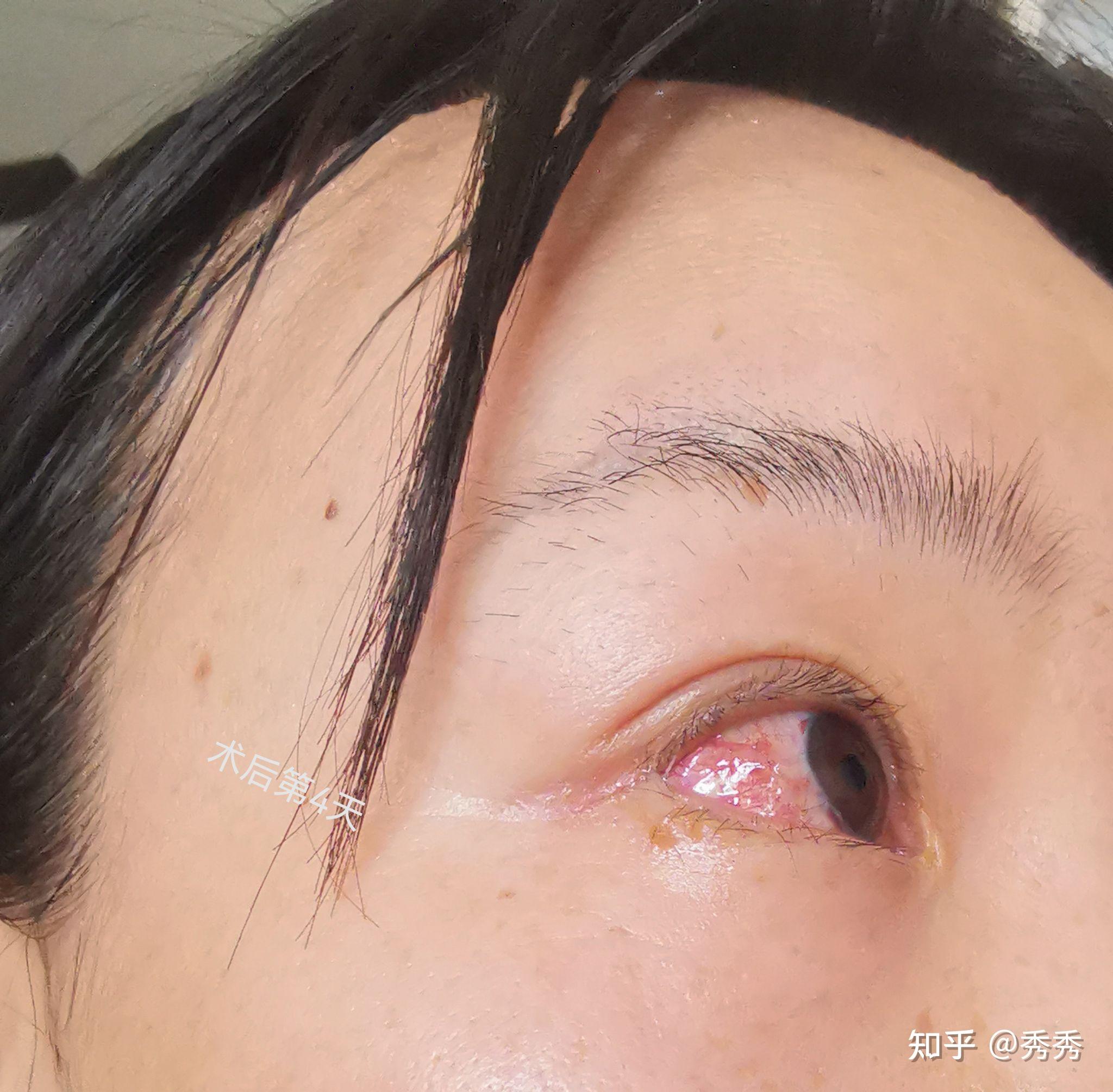 眼结膜囊肿手术前后对照