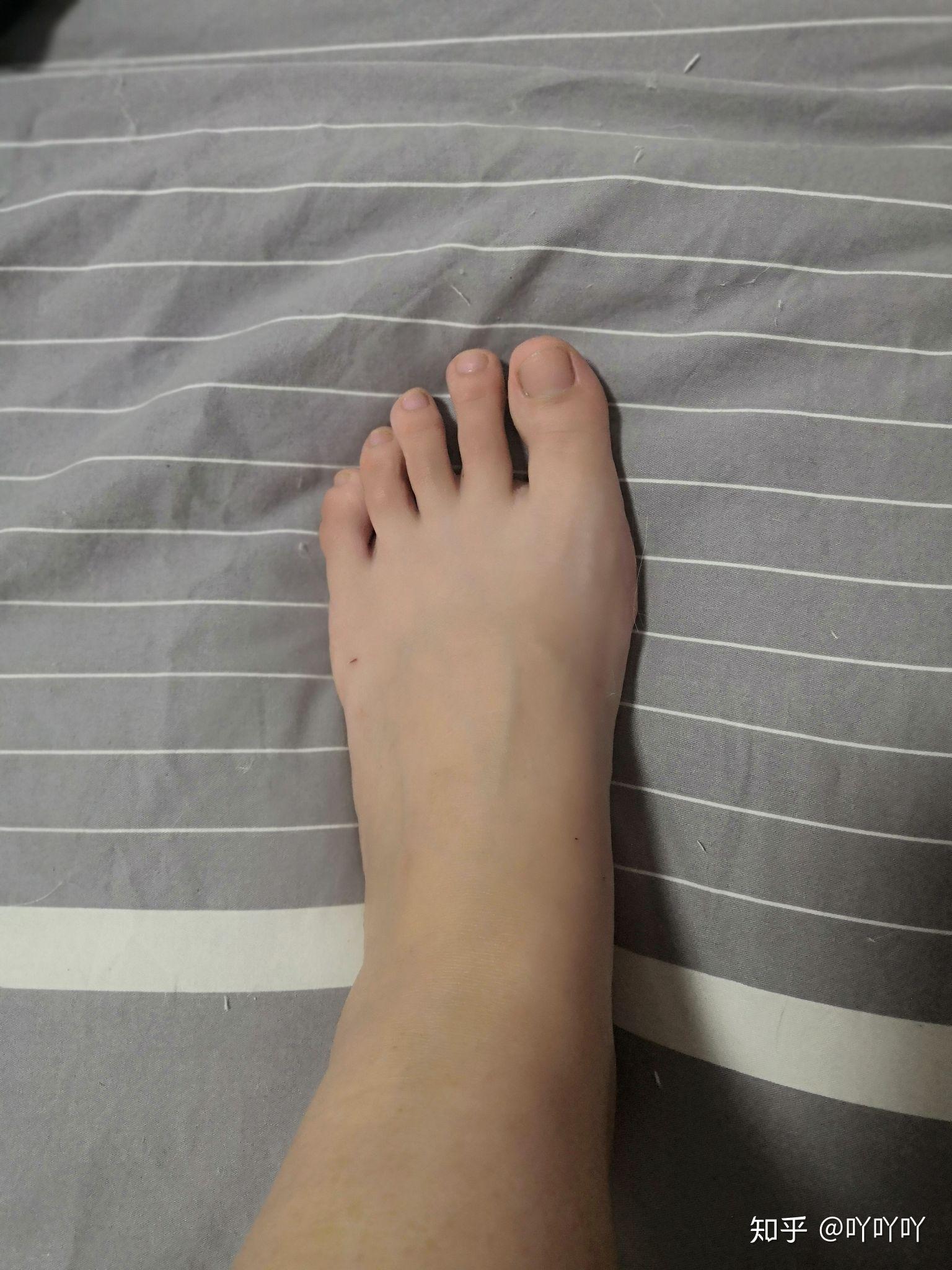 女生脚踝粗是基因决定的吗