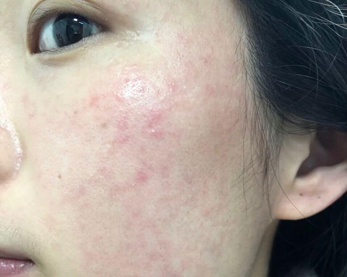 敏感肌脸泛红的你们用过最好用的护肤品是什么? - 知乎
