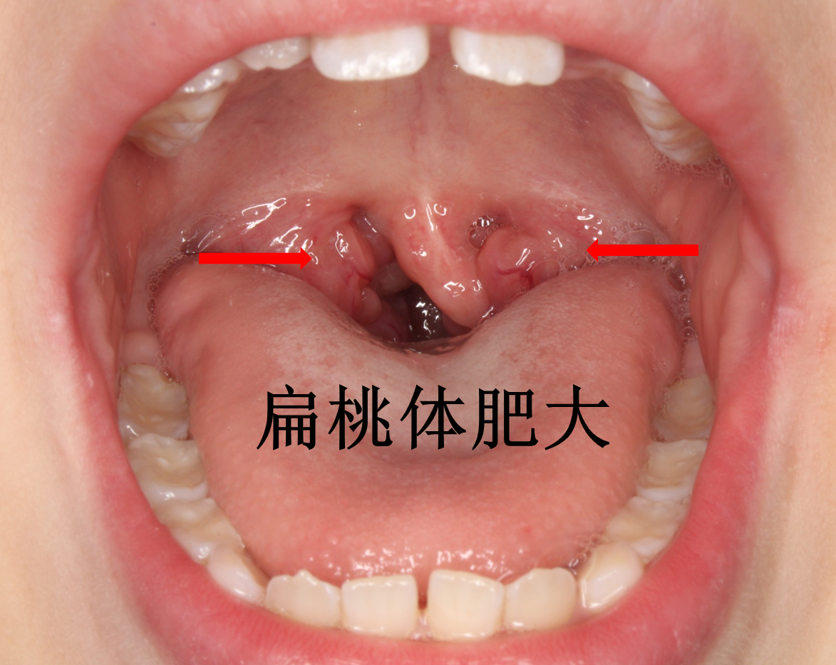 喉咙腭垂肿大图片